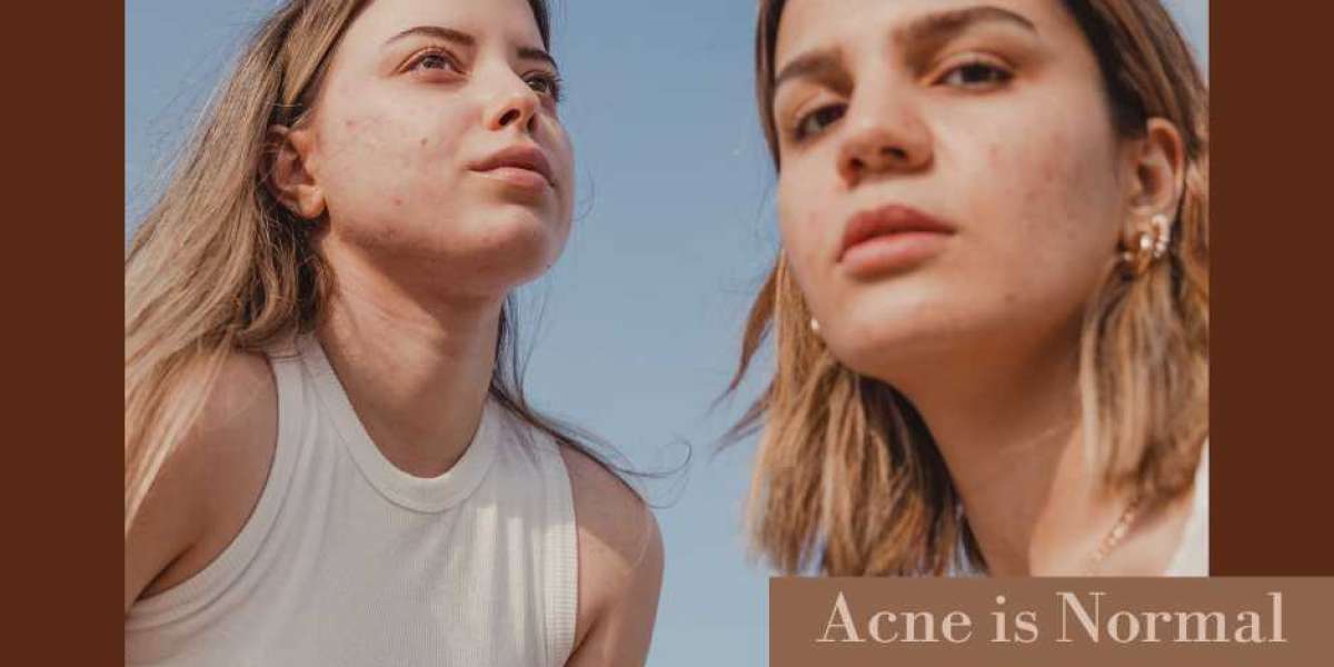 Achieve Self-Beauty: A Guide to an Acne Free Face